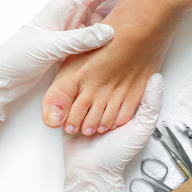 Pedicure, podologist. Patient on medical pedicure procedure, nail disease, cholesis detachment of the nail plate. Foot care, treatment in a medical spa salon.